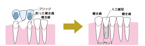 写真:ブリッジからインプラントにする場合