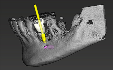 写真：シミュレーションソフトによるインプラント埋入計画