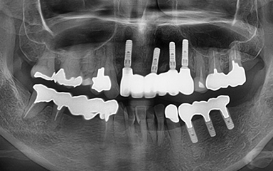 写真:MIインプラントと治療方法手順の工夫