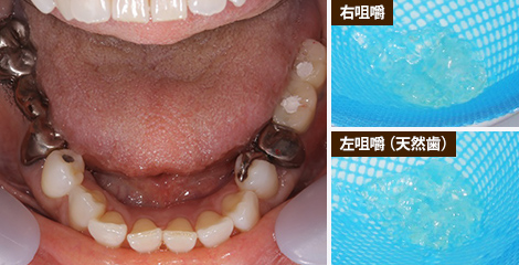 写真:治療後の咀嚼力110mg/dL、左(天然歯)は198mg/dL