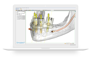 写真：シミュレーションソフトのSimplant