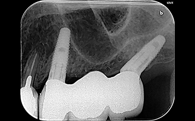 写真：傾斜埋入インプラント