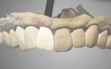 写真：インプラントのシミュレーション映像