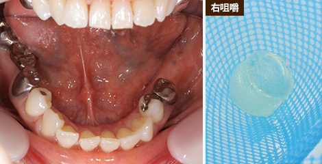 写真：治療前の咀嚼力21mg/dL