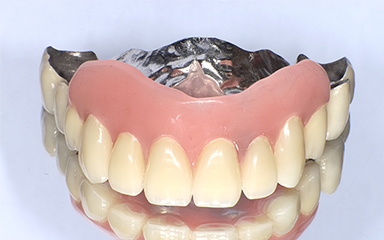 写真：インプラント義歯の裏面