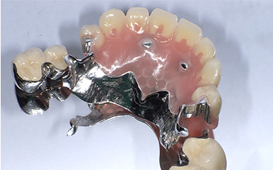 写真：インプラント義歯の前面