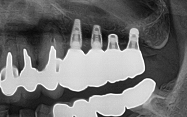 写真：ショートインプラント