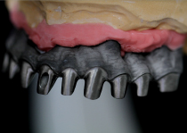 写真：CAD／CAMで作った歯