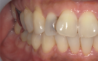 写真：前歯に大きな虫歯