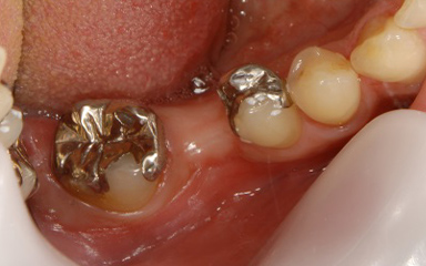 写真：銀歯と歯のない部分の様子