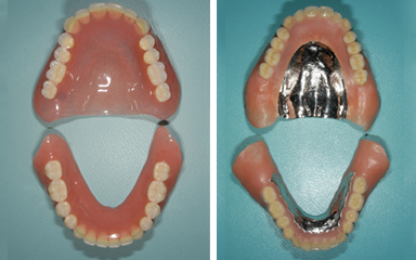 写真：金属床義歯