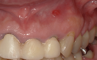 写真：治療前の腫れている歯茎