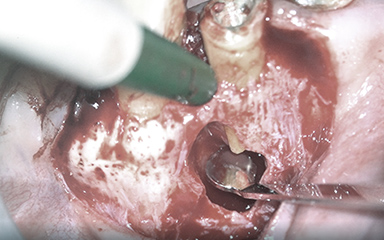 写真：歯根端切除術の様子