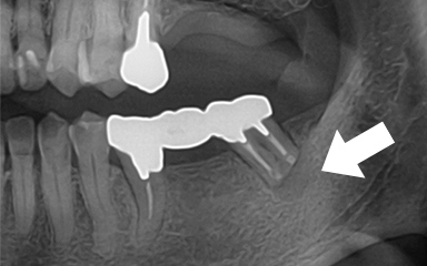 写真：病巣が取れきれいになった様子