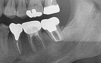 写真：CTでも病巣がなくなっている