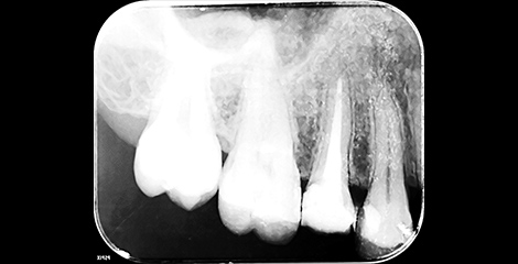 写真：MTAを用いた根管充填