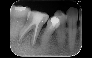 写真： ニッケルチタンファイルによる治療