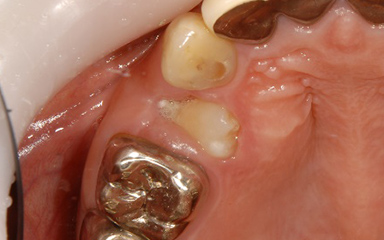 写真：治療前、歯が歯肉に埋まっている