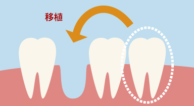 図：移植術