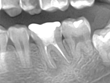 写真：なかなか膿が出るのが止まらない