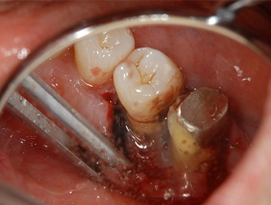 写真：歯周外科