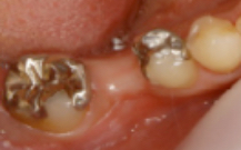 写真：銀歯と歯のない部分