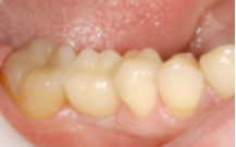 写真：セラミックスの歯を入れた状態